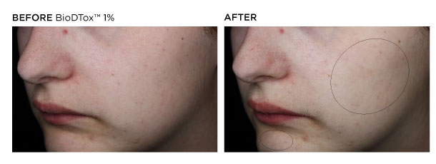 The image shows a comparison of a person's scalp before and after a hair treatment or hair restoration procedure. In the "before" picture, the scalp appears to have thinning hair or bald spots. In the "after" picture, the hair looks fuller and denser, indicating successful hair regrowth or coverage. The overall improvement suggests the effectiveness of the treatment used.