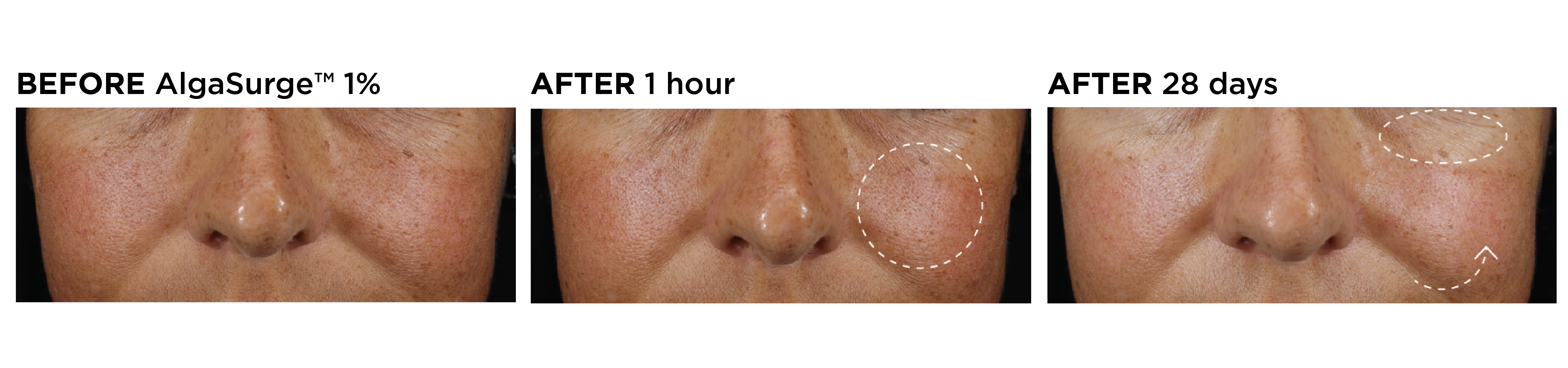 Close-up images of a woman's face showing skin texture before, 1 hour after, and 28 days after applying 1% AlgaSurge, highlighting visible skin improvement and reduced wrinkles.