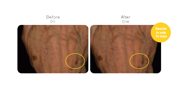 The image shows a comparison of a hand before and after 14 days of treatment. The dark spot circled in yellow on the hand appears lighter and less prominent in the "After" image (D14) compared to the "Before" image (D0). This suggests that the treatment has reduced the appearance of the dark spot within 14 days.