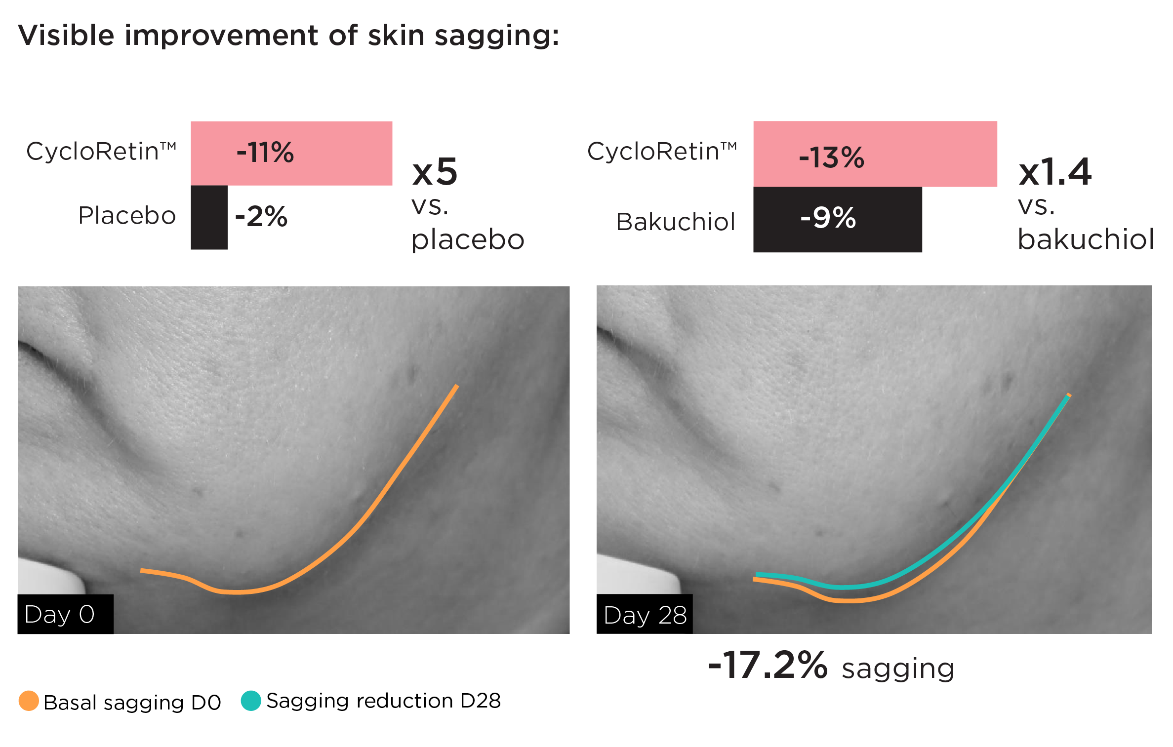 The image presents data on the visible improvement of skin sagging using CycloRetin™ compared to placebo and bakuchiol.

Key points:
- CycloRetin™ shows an 11% improvement in skin sagging versus a 2% improvement with placebo, making it 5 times more effective than placebo.
- CycloRetin™ shows a 13% improvement in skin sagging versus a 9% improvement with bakuchiol, making it 1.4 times more effective than bakuchiol.
- The photos show a side-by-side comparison of skin sagging on Day 0 and Day 28.
- On Day 0, the basal sagging is marked with an orange line.
- On Day 28, sagging reduction is marked with a turquoise line, showing a visible reduction in sagging.
- The overall sagging reduction is quantified as -17.2%.

This suggests that CycloRetin™ significantly improves skin sagging over 28 days compared to placebo and bakuchiol.
