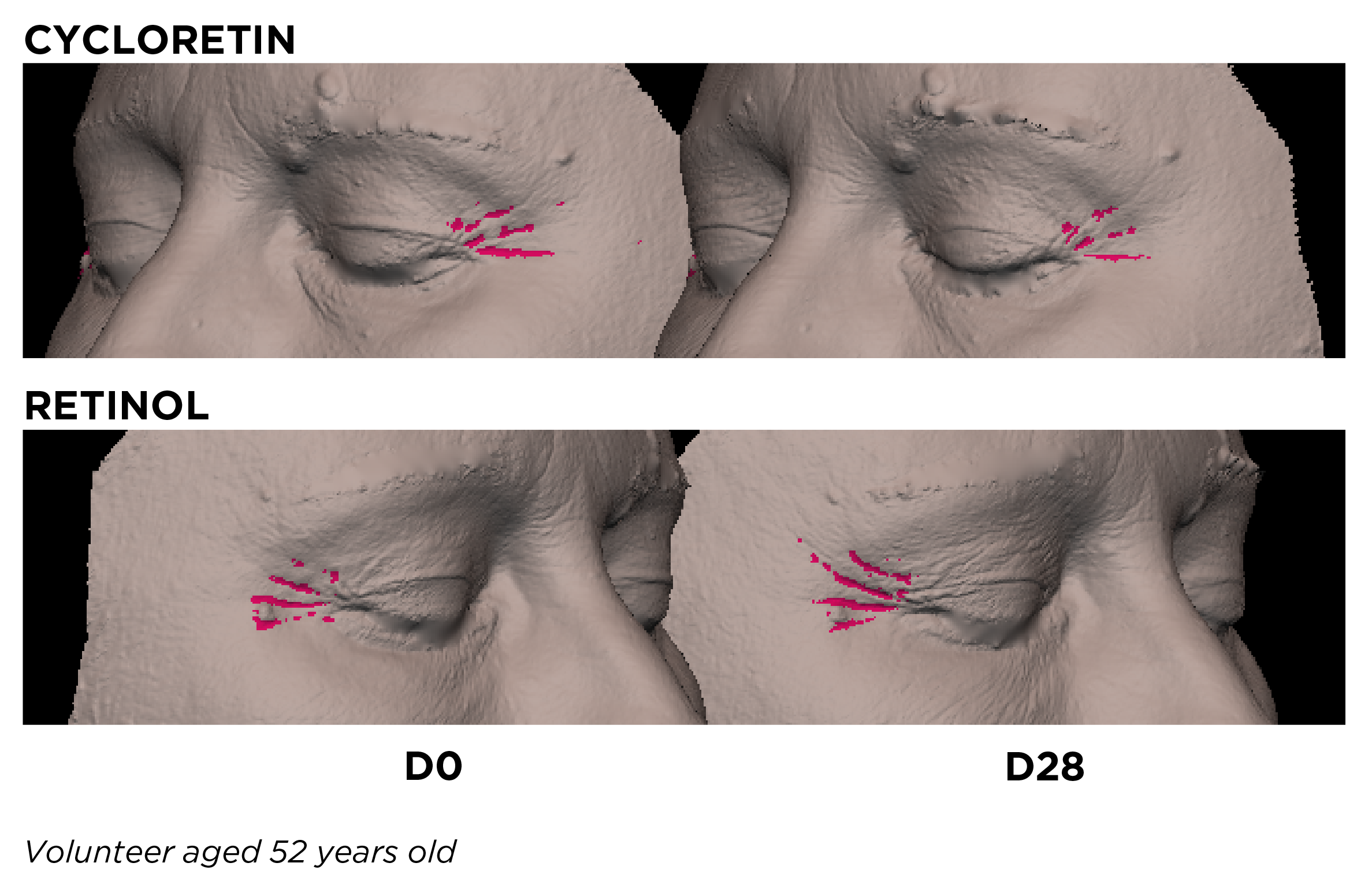 The image appears to be a comparison graphic showing a close-up of a person’s eye area with labels:

- **CYCLORETIN** at the top
- **RETINOL** in the middle
- **DO** near the bottom
- Text at the bottom left: **“Volunteer aged 52 years old”**

The eye images show pink highlighted areas around the outer corner of the eye, likely indicating wrinkles or treatment effect zones. A large gray rectangle obscures much of the right side of the image, so the full comparison isn’t visible.

If you want, I can also help describe the image in more detail or extract the visible text exactly.