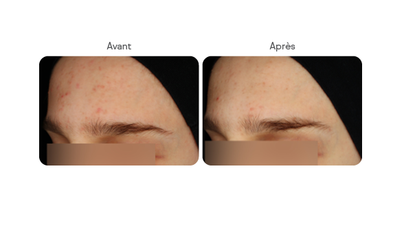 Side-by-side comparison of a forehead before and after acne treatment showing reduced redness and clearer skin.