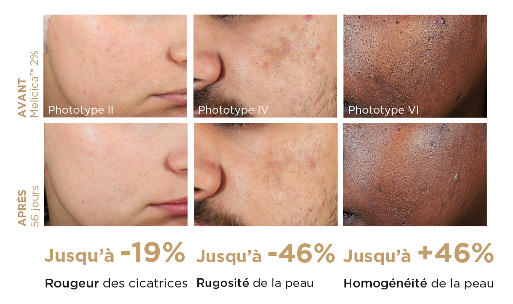The image shows a comparison of skin conditions before and after 56 days of using Melicica™ 2% on different phototypes (II, IV, VI). 

- For Phototype II, there is a reduction in the redness of scars by up to 19%.
- For Phototype IV, there is a reduction in skin roughness by up to 46%.
- For Phototype VI, there is an improvement in skin homogeneity by up to 46%.

The "Avant" (before) images are on the top row, and the "Après" (after) images are on the bottom row, showing visible improvements in skin condition after treatment.